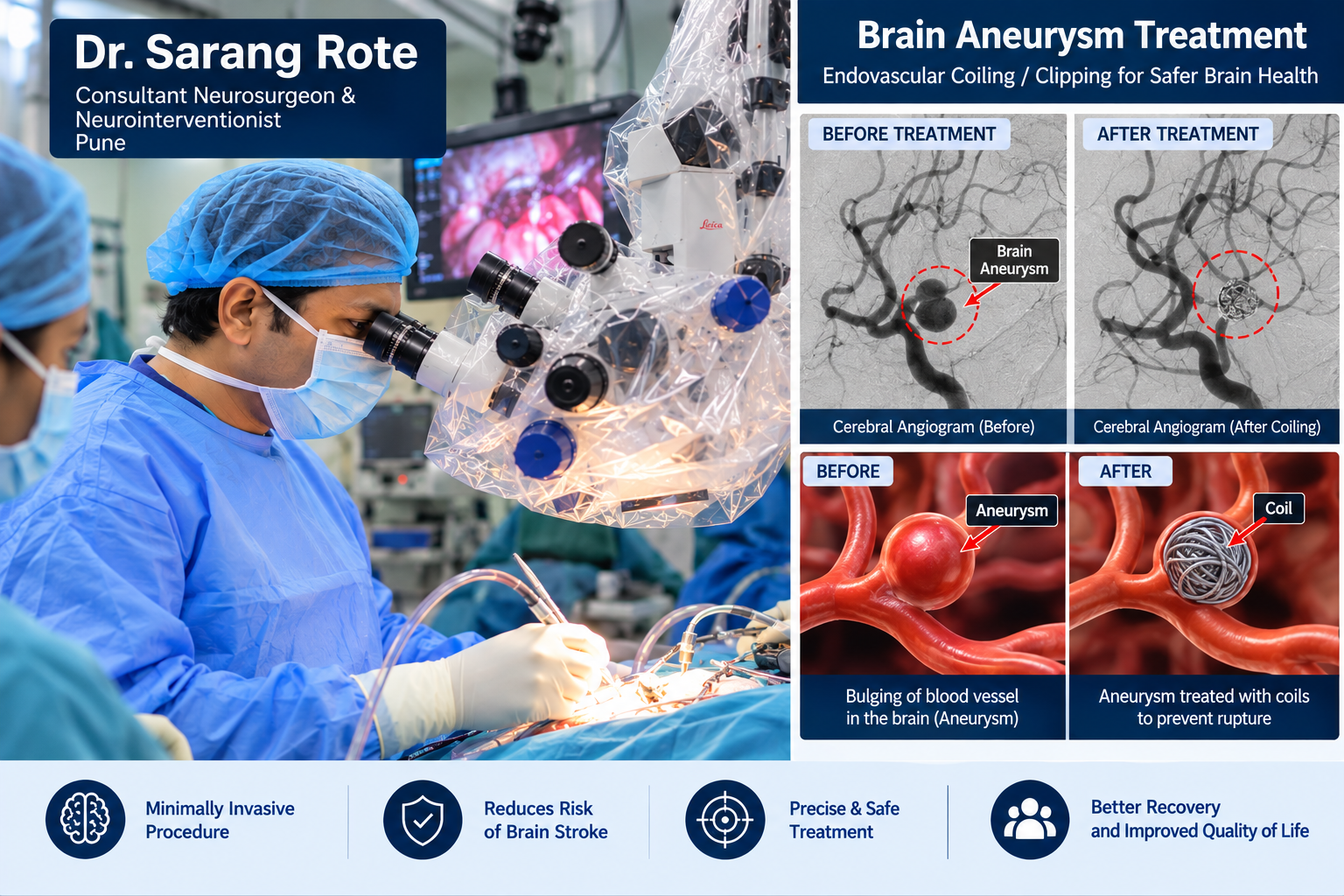 Brain Aneurysm Treatment in Pune by Dr. Sarang Rote